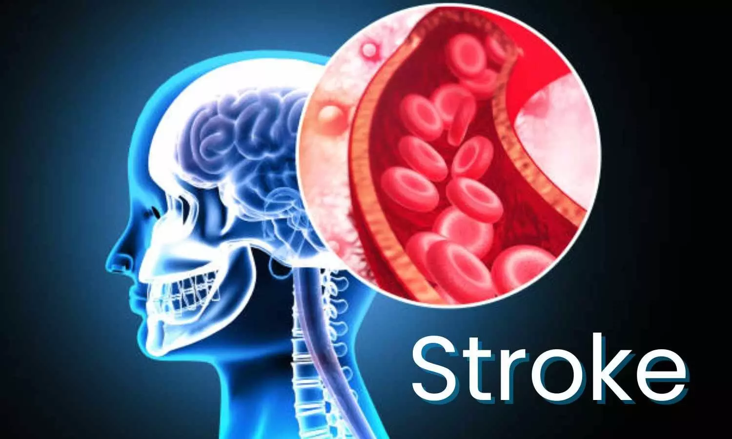 High HbA1c Linked to Vascular Dysfunction in Lacunar Stroke, suggests research