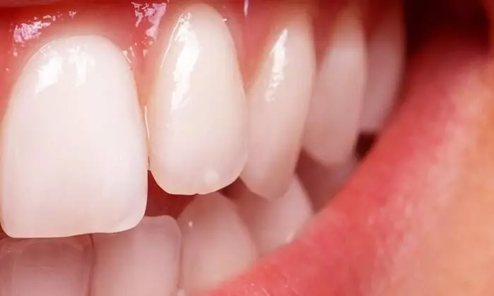 Short Fiber-Reinforced Composites may improve fracture resistance in posterior restorations: Study