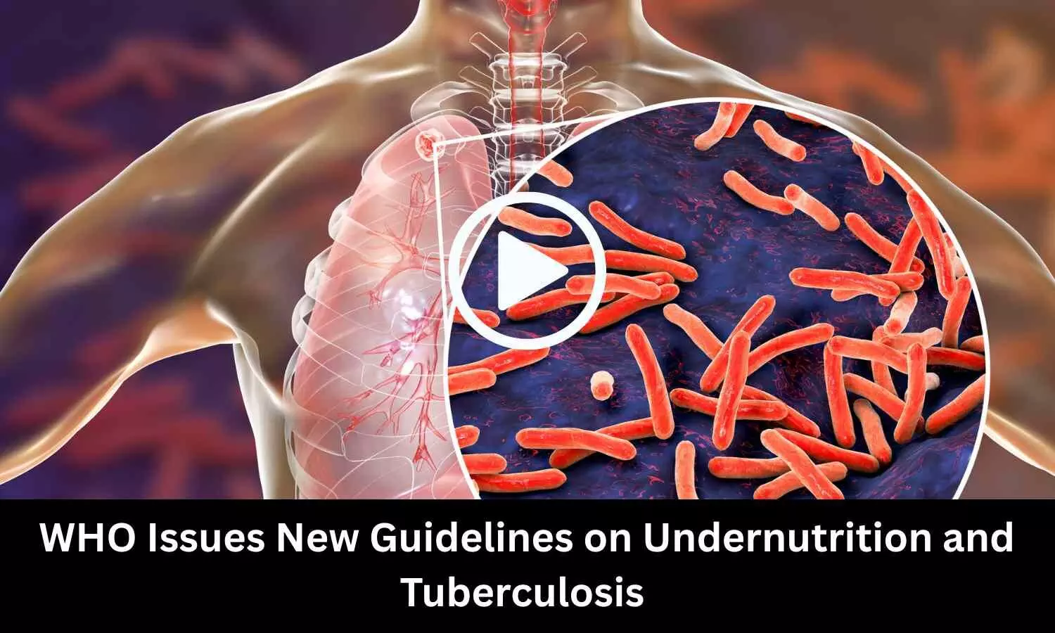 WHO Issues New Guidelines on Undernutrition and Tuberculosis