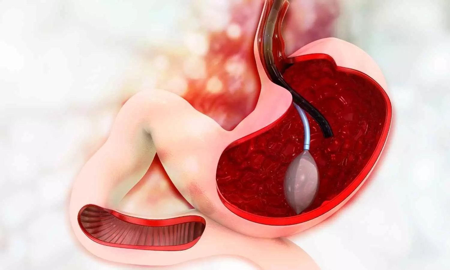 Balloon Dilation Safe and Effective for Bile Duct Stones, finds Study