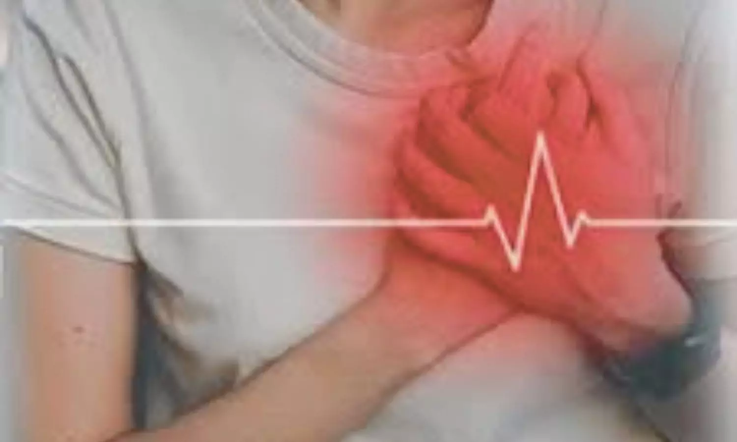 Uterine Fibroids Linked to 50 Percent Higher Risk of Atrial Fibrillation in Young Women: Study