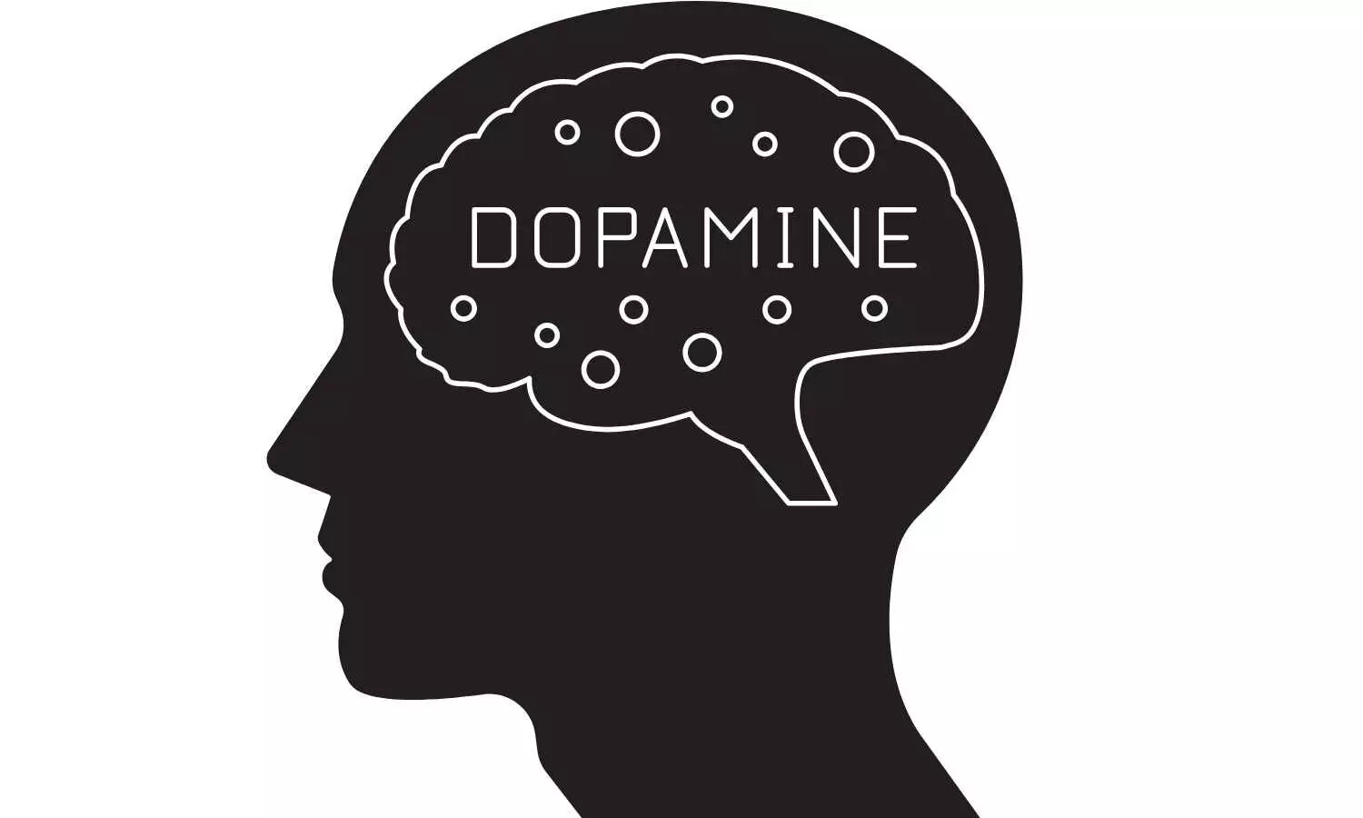 Levodopa Shows No Added Benefit for Motor Recovery in Acute Stroke Rehabilitation: JAMA