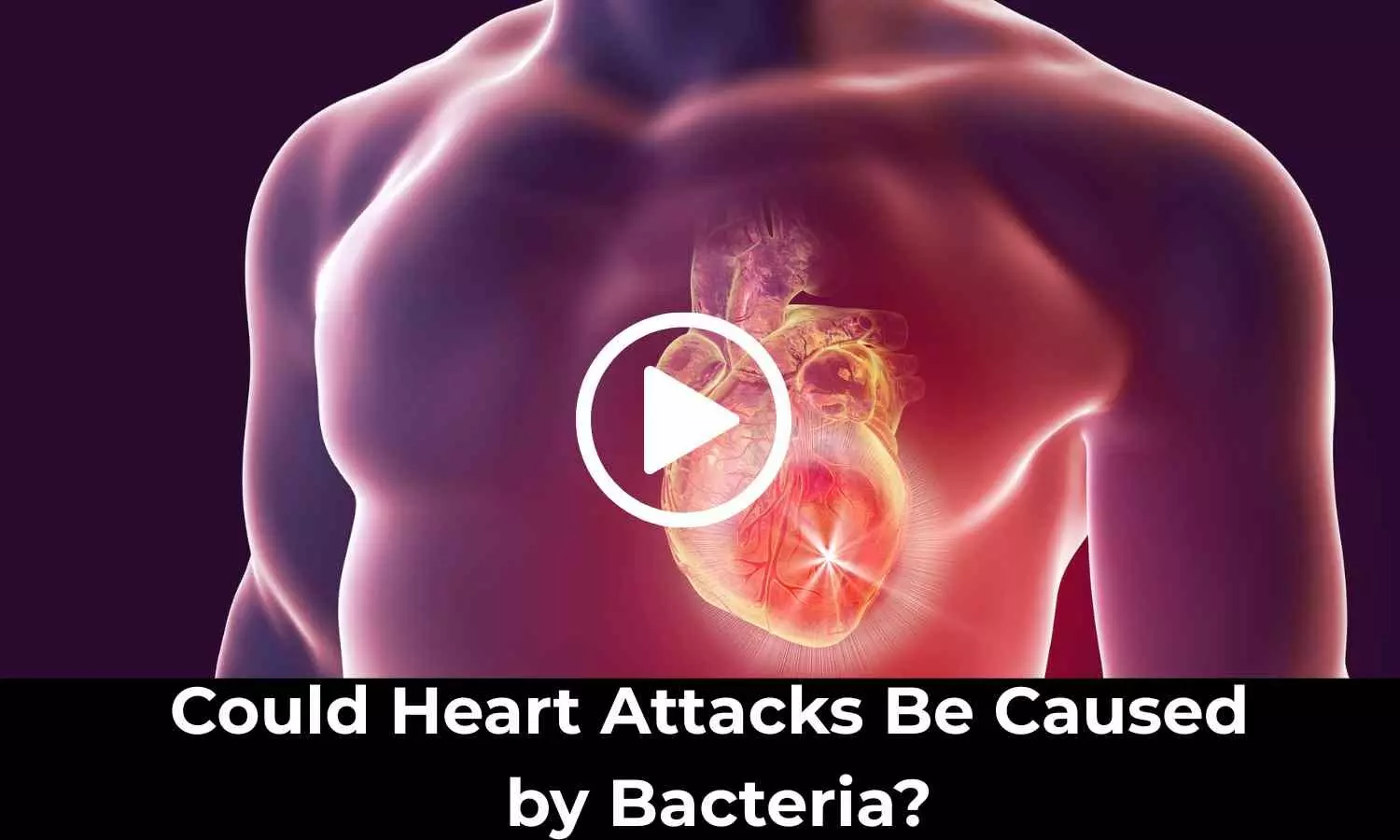 Could Heart Attacks Be Caused by Bacteria? Study Provide Insights