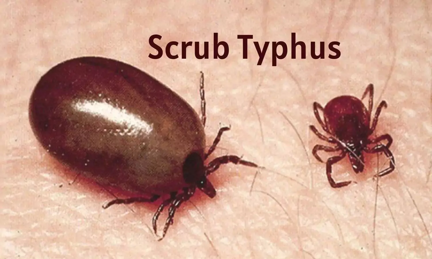 Mizoram faces Scrub Typhus surge, warn health experts