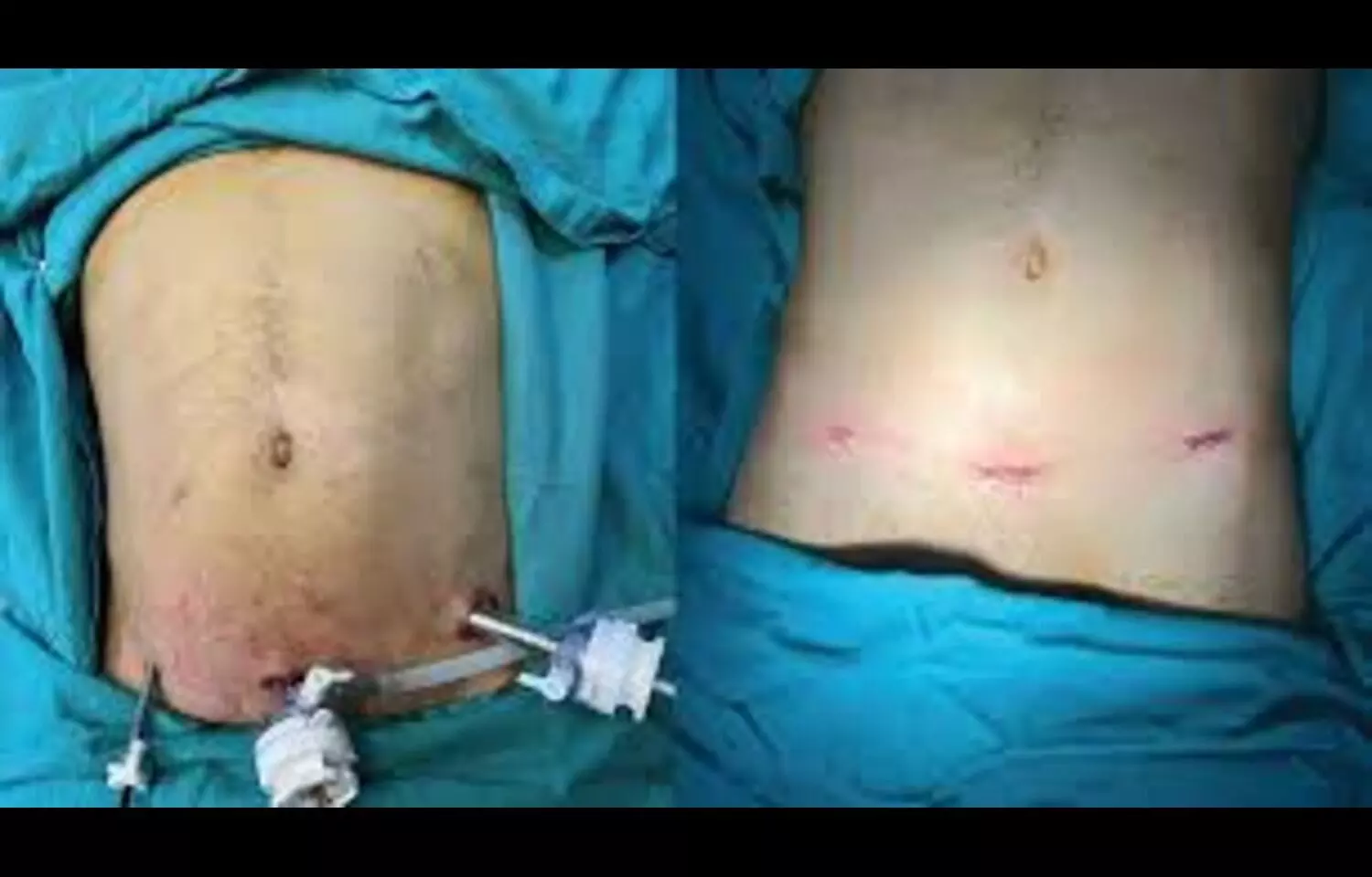 Routine Abdominal Drain Not Recommended After Laparoscopic Appendectomy for Perforated Appendicitis: Study