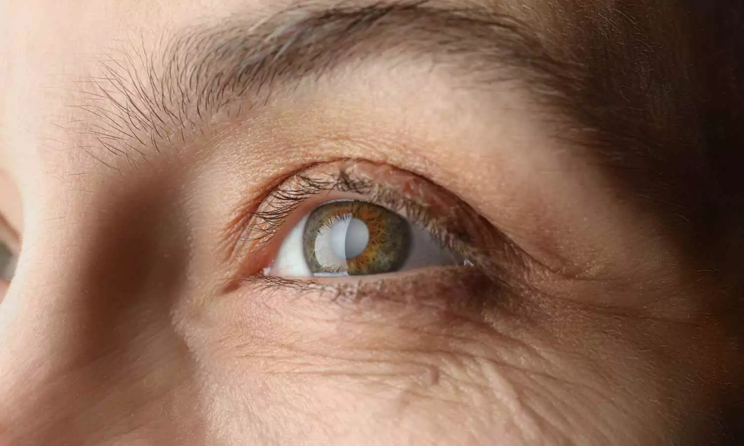 Study finds elevated risk of mortality in individuals with glaucoma