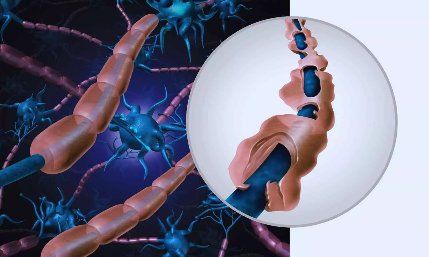 New blood test shows promise in detecting ALS early