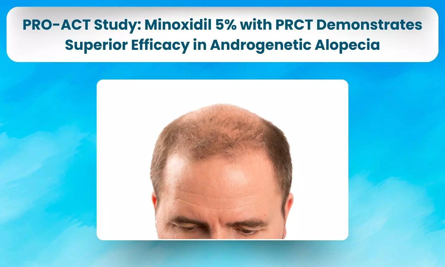 PRO-ACT Study Compares Topical Minoxidil 5% with PRCT vs Plain Minoxidil 5% in Androgenetic Alopecia-Combination Shows Superior Efficacy