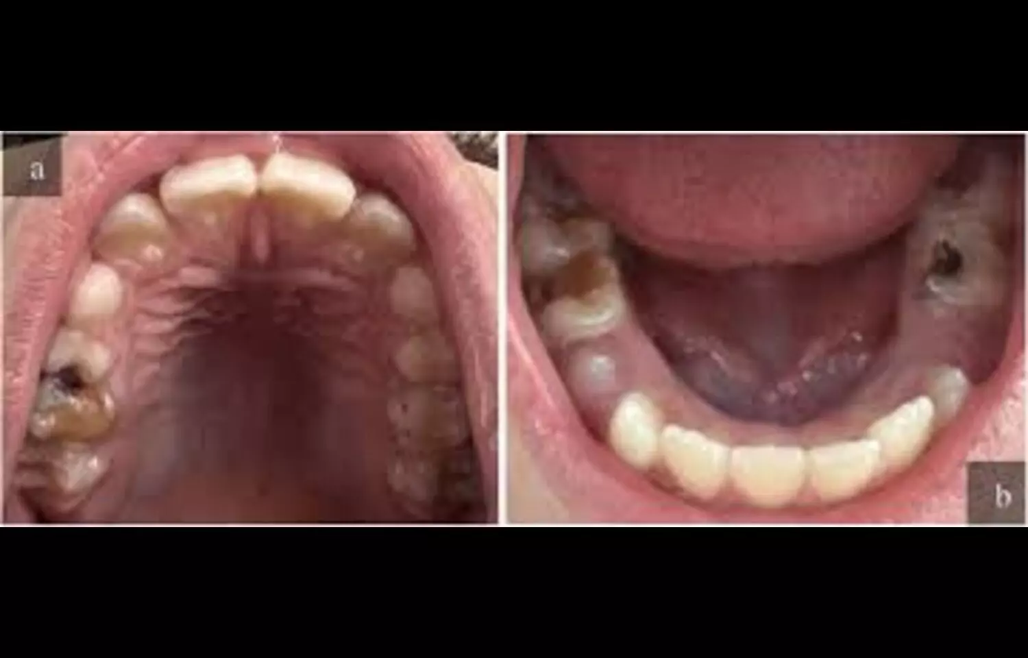 Caries Detection in Orthodontic Patients by smartphone photography Shows High Sensitivity but Low Specificity: Study