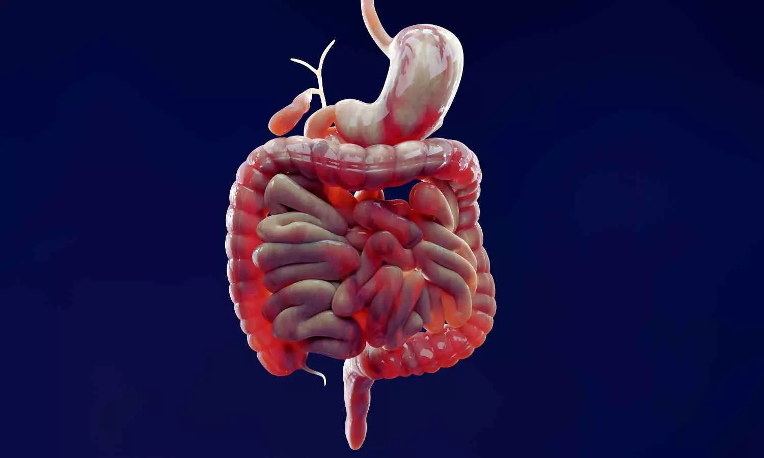 AI analysis of colonoscopy improves assessment of Crohn's disease: Study