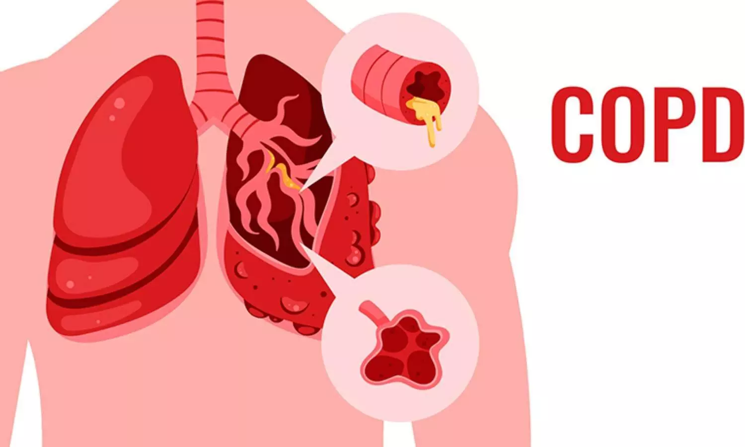 CAT-Based Definition Better Predicts COPD Mortality Risk, reports research
