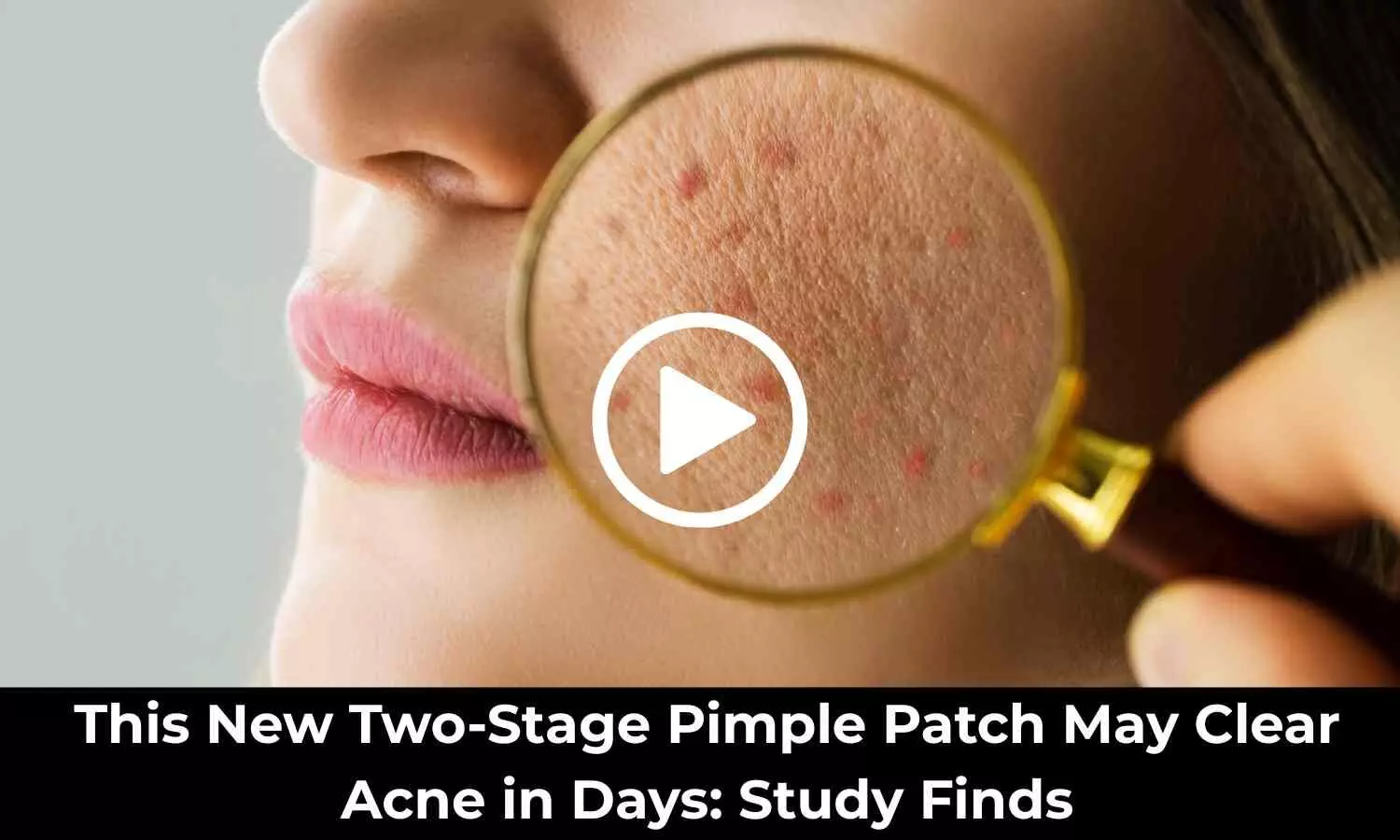 This New Two-Stage Pimple Patch May Clear Acne in Days: Study Finds
