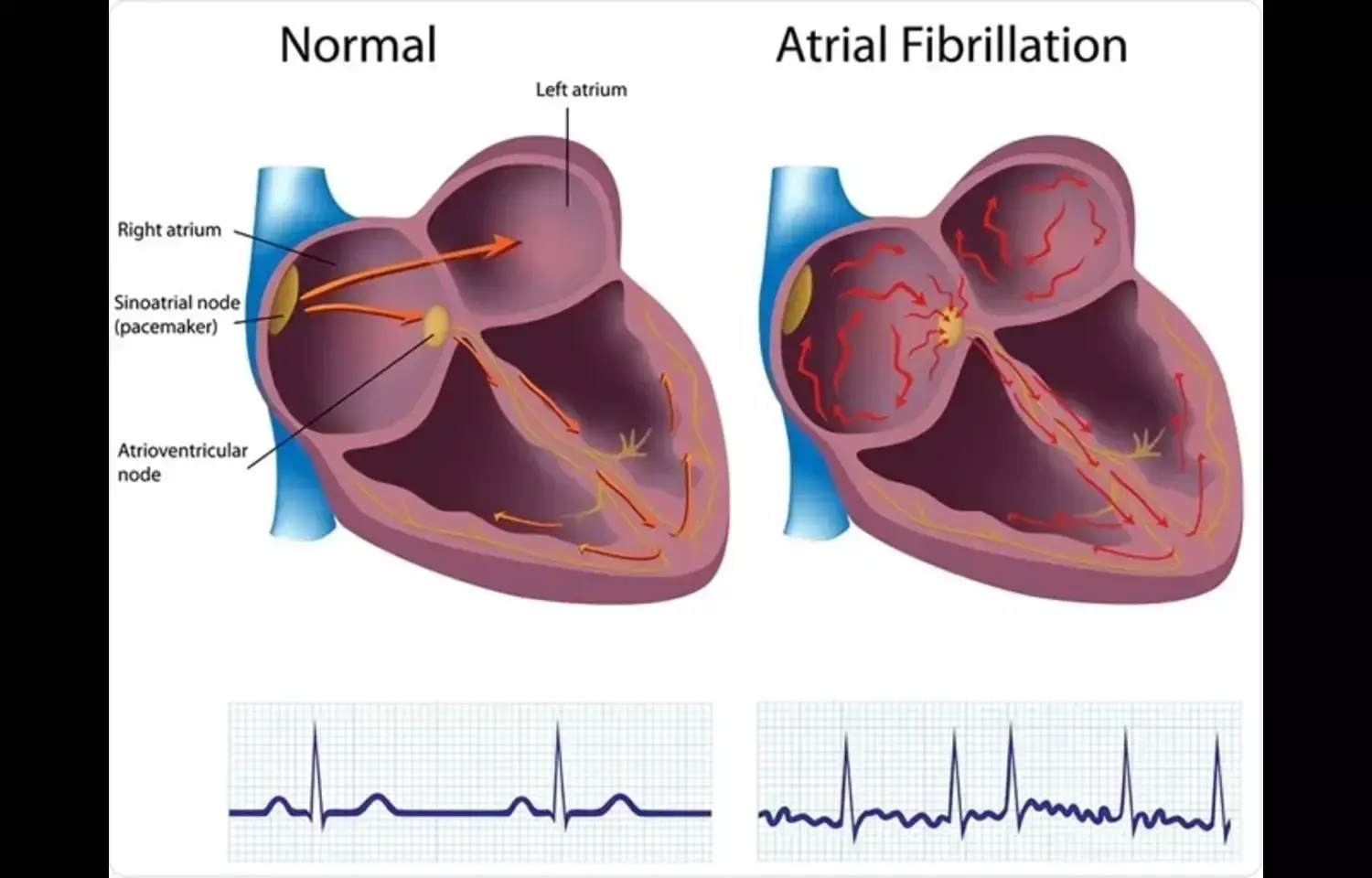 Lactate-to-Albumin Ratio Predicts Mortality in Hypertensive Patients with AF: Study