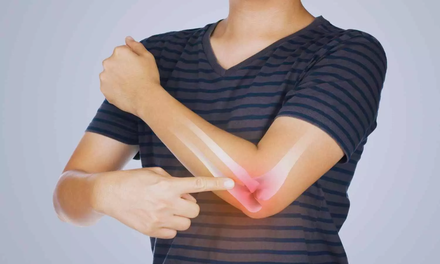 Safe Use of WALANT Technique for Safe WALANT Technique for Mini-Open Ulnar Nerve Decompression at Elbow Safe surgicaloption: Study