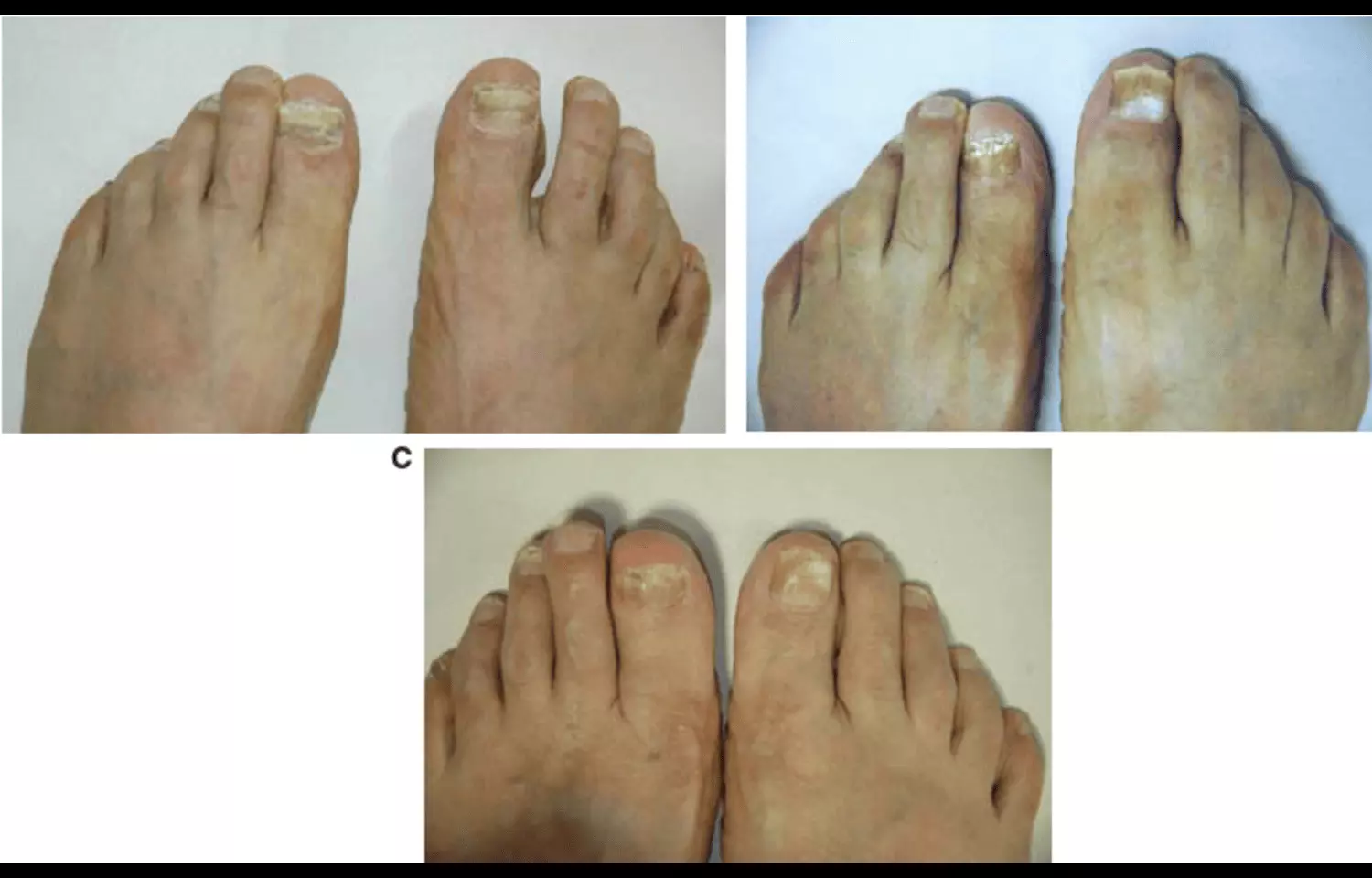 Crisaborole Boosts Effectiveness of Amorolfine in Keratinized Tinea Foot: Study