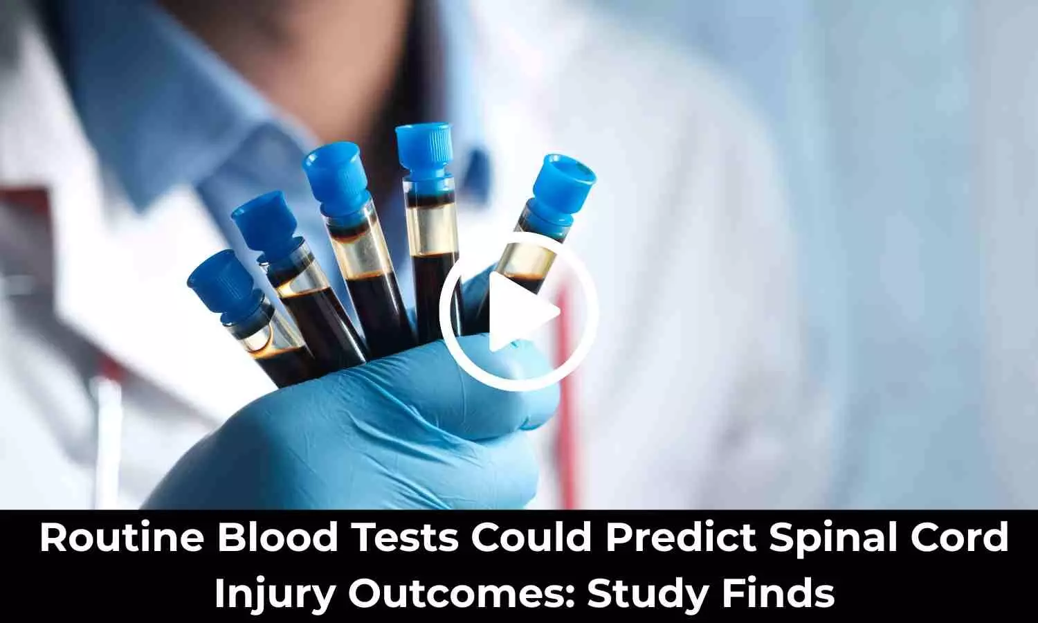 Routine Blood Tests Could Predict Spinal Cord Injury Outcomes: Study Finds