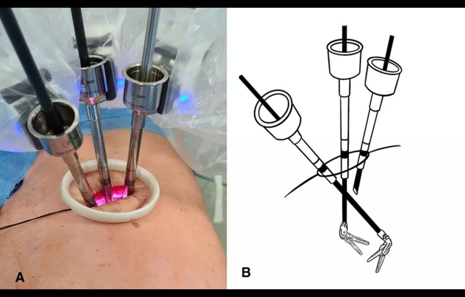 Uniportal robotic-assisted thoracic surgery Shows Better Postoperative Recovery Than MRATS: Study