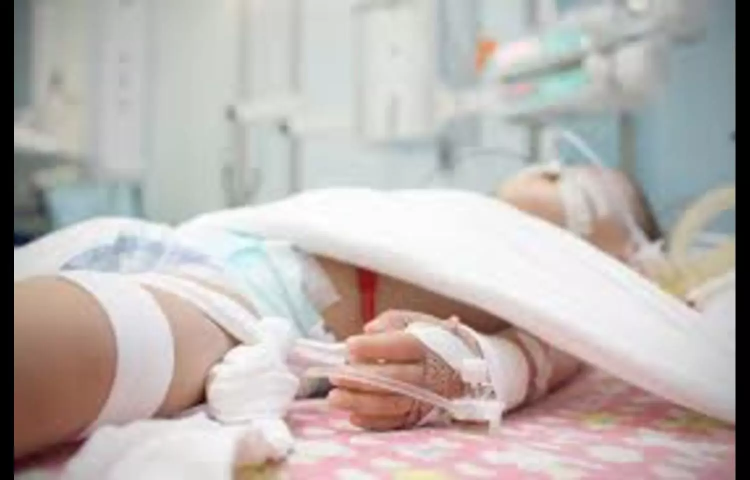 Red Blood Cell Distribution Width Flags Increased Mortality in Critically Ill Children: Study