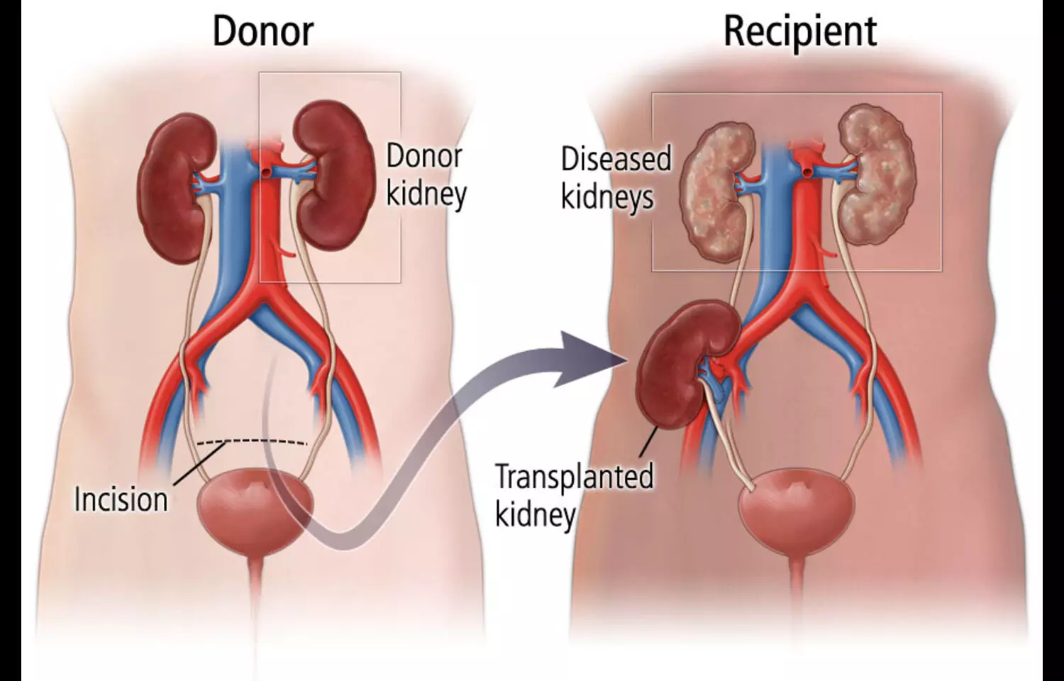 Steroidal MRAs Ineffective and Risky in Kidney Transplant Recipients: Study