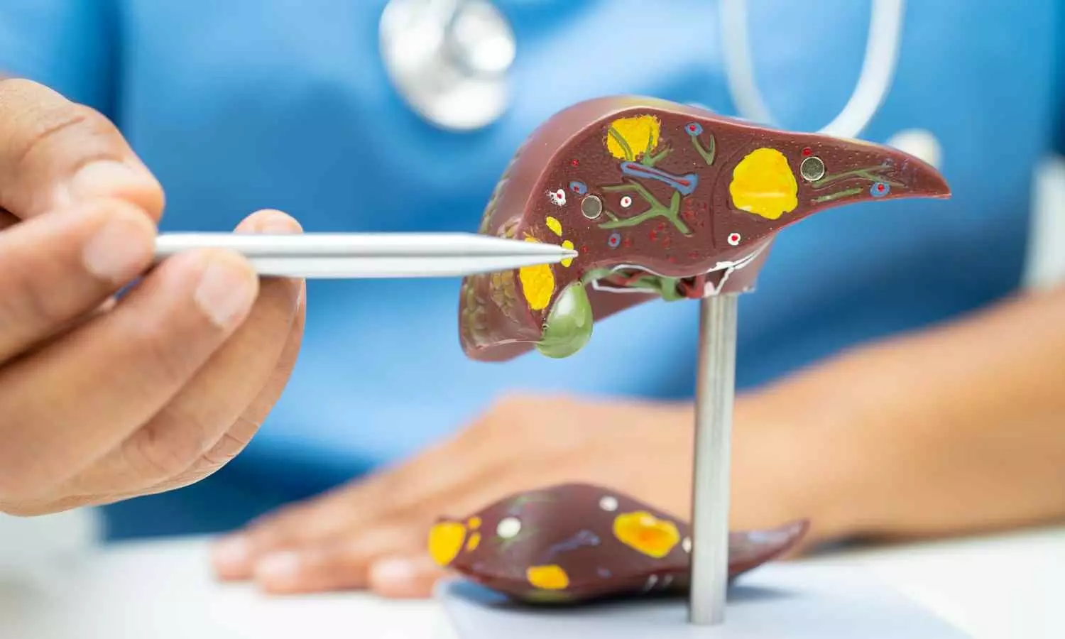Tirzepatide- A novel therapeutic against metabolic dysfunction-associated steatotic liver disease, reports research