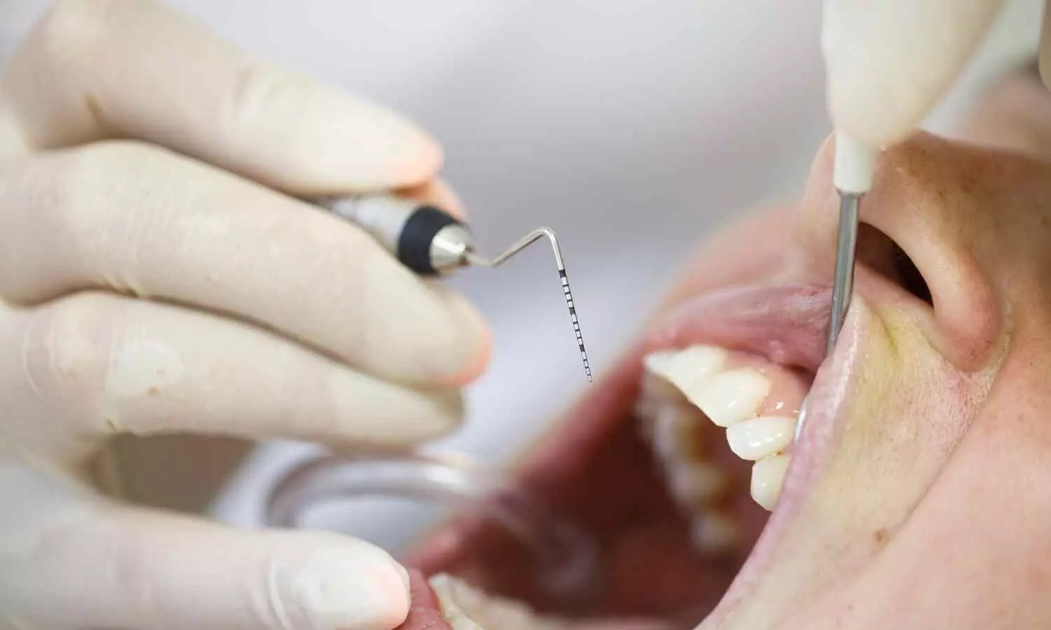 High Blood Sugar Levels may Increase Risk of Periodontal Disease: Study
