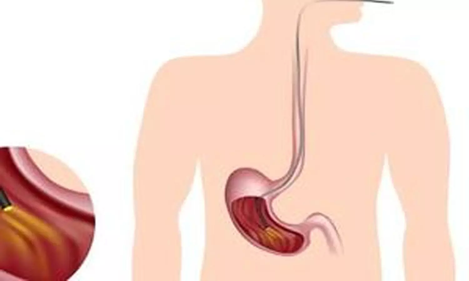 Simple Airway Device Slashes Hypoxemia Risk During Endoscopy: Study Shows