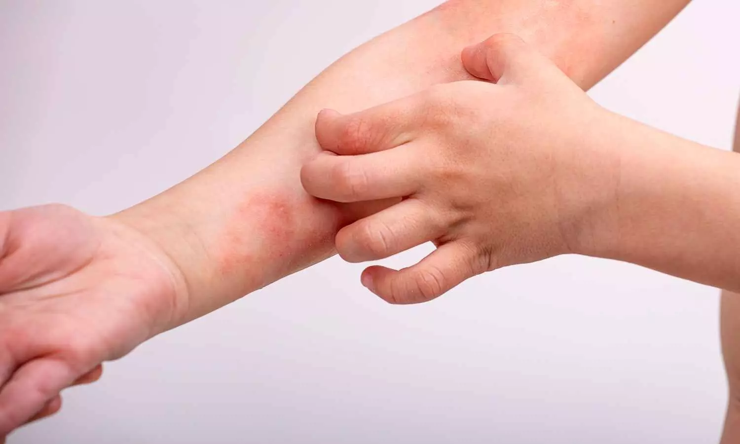 Atopic Dermatitis Significantly Raises Risk of Fibromyalgia, New Study Shows