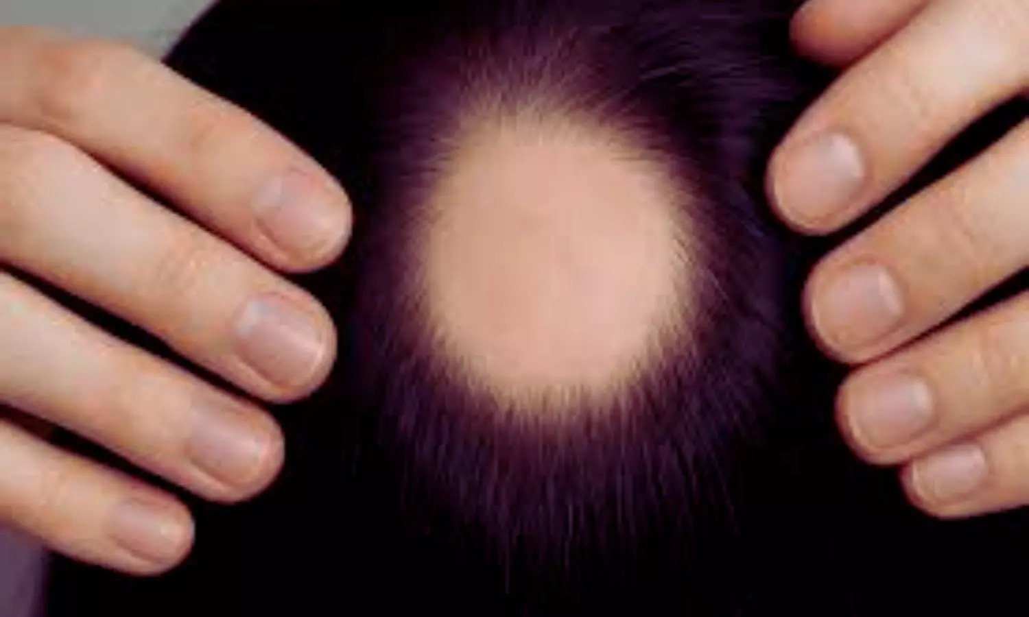 Baricitinib not linked to increased VTE Risk in Alopecia Areata Patients: Study