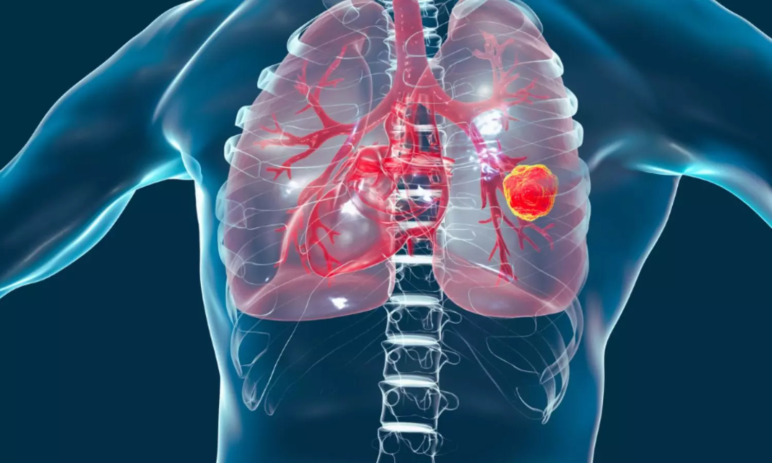 Video assisted thoracoscopy surgery reduces mortality by 21 percent compared to lobectomy: Study