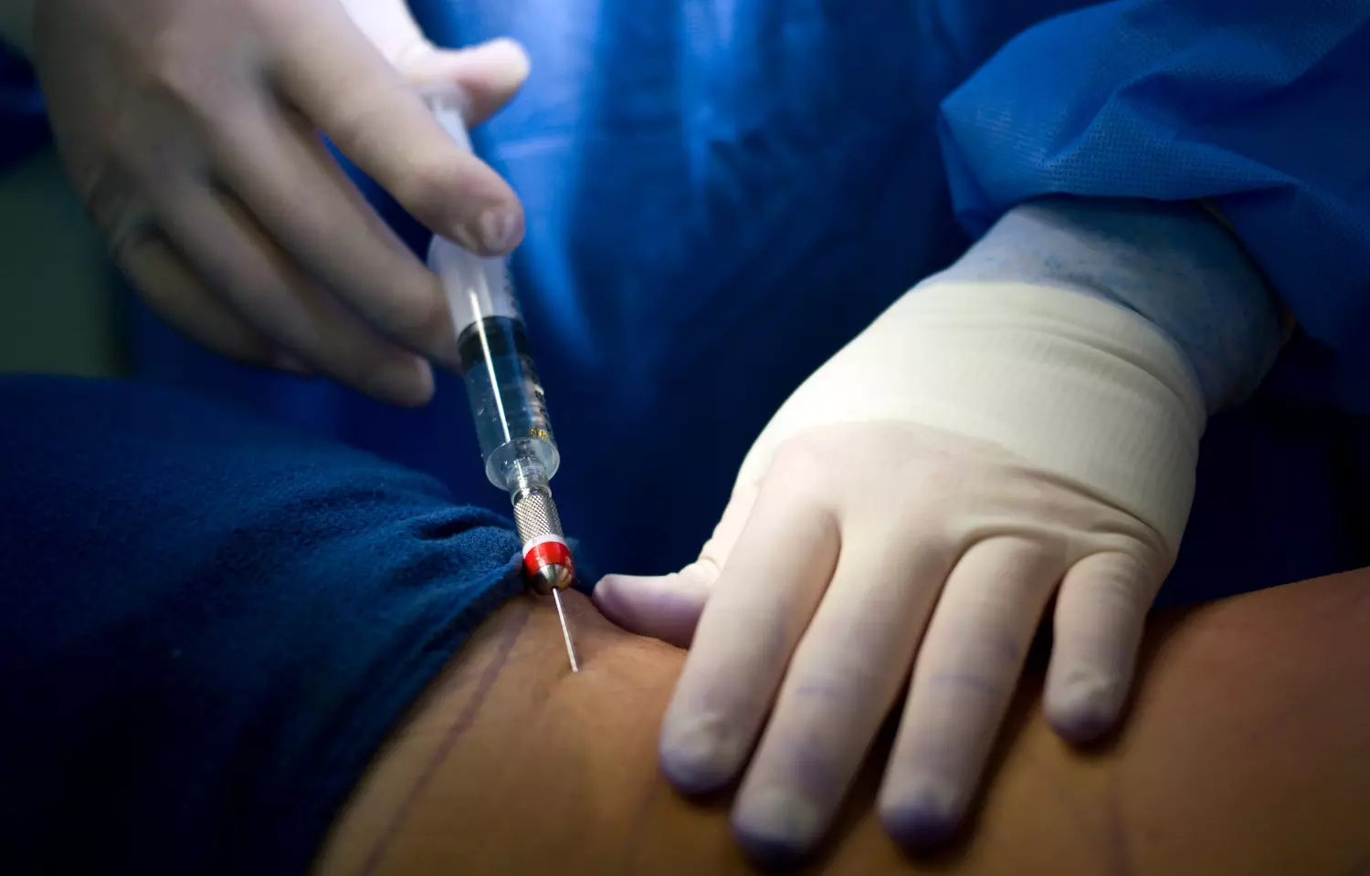 Perfusion Index may Predict for SAIH in Orthopedic Surgery, Less Effective in Elderly: Study