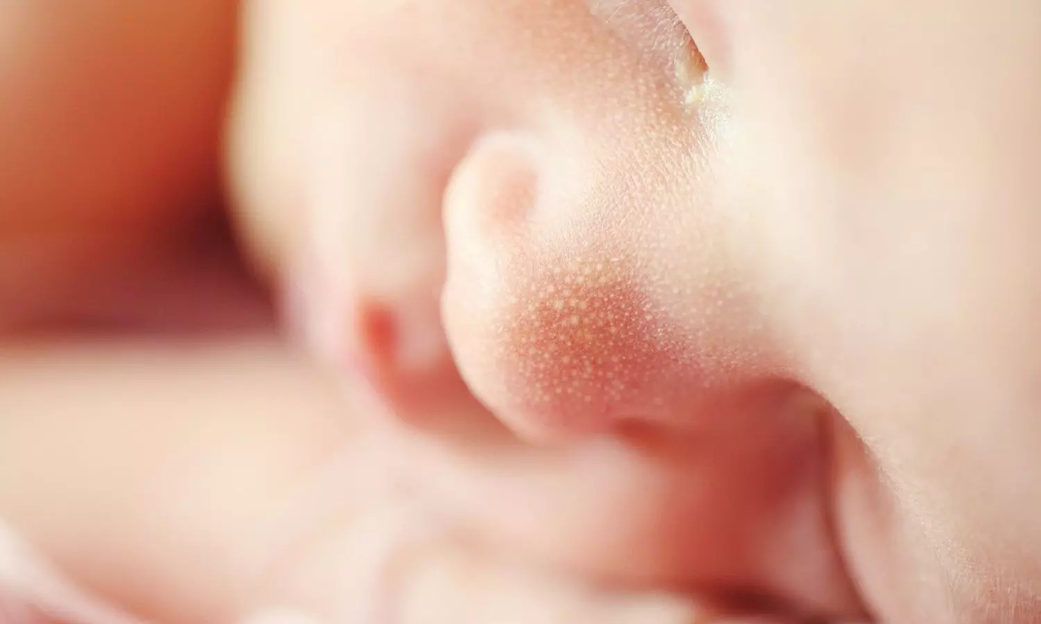 Shunting Benefits in Idiopathic Normal-Pressure Hydrocephalus: NEJM