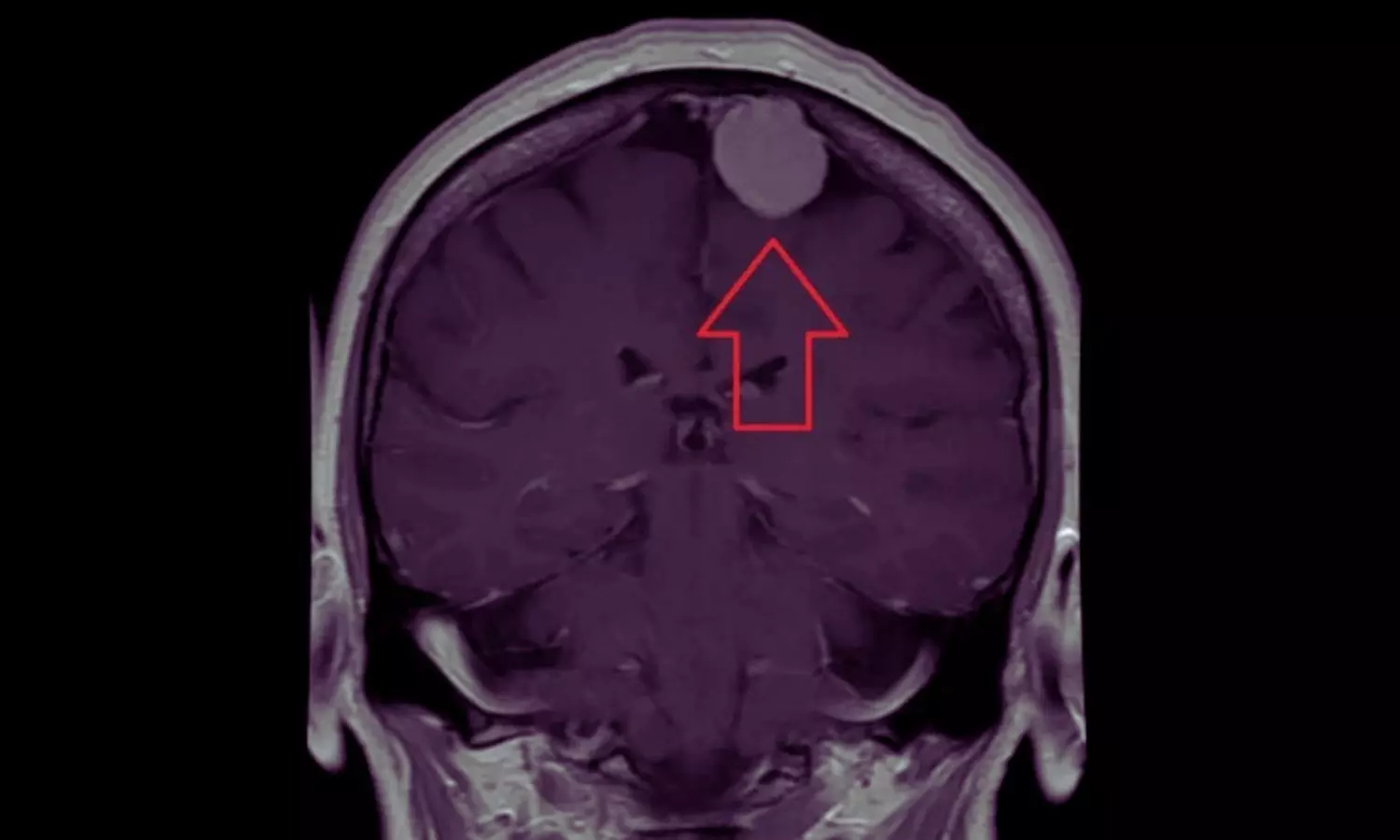 Depot Medroxyprogesterone Acetate Use Linked to Higher Meningioma Risk in Women: JAMA
