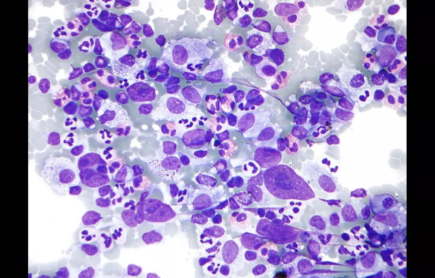 Cervical Cancer and Hodgkin Lymphoma Linked to Higher ASCVD Risk: Study