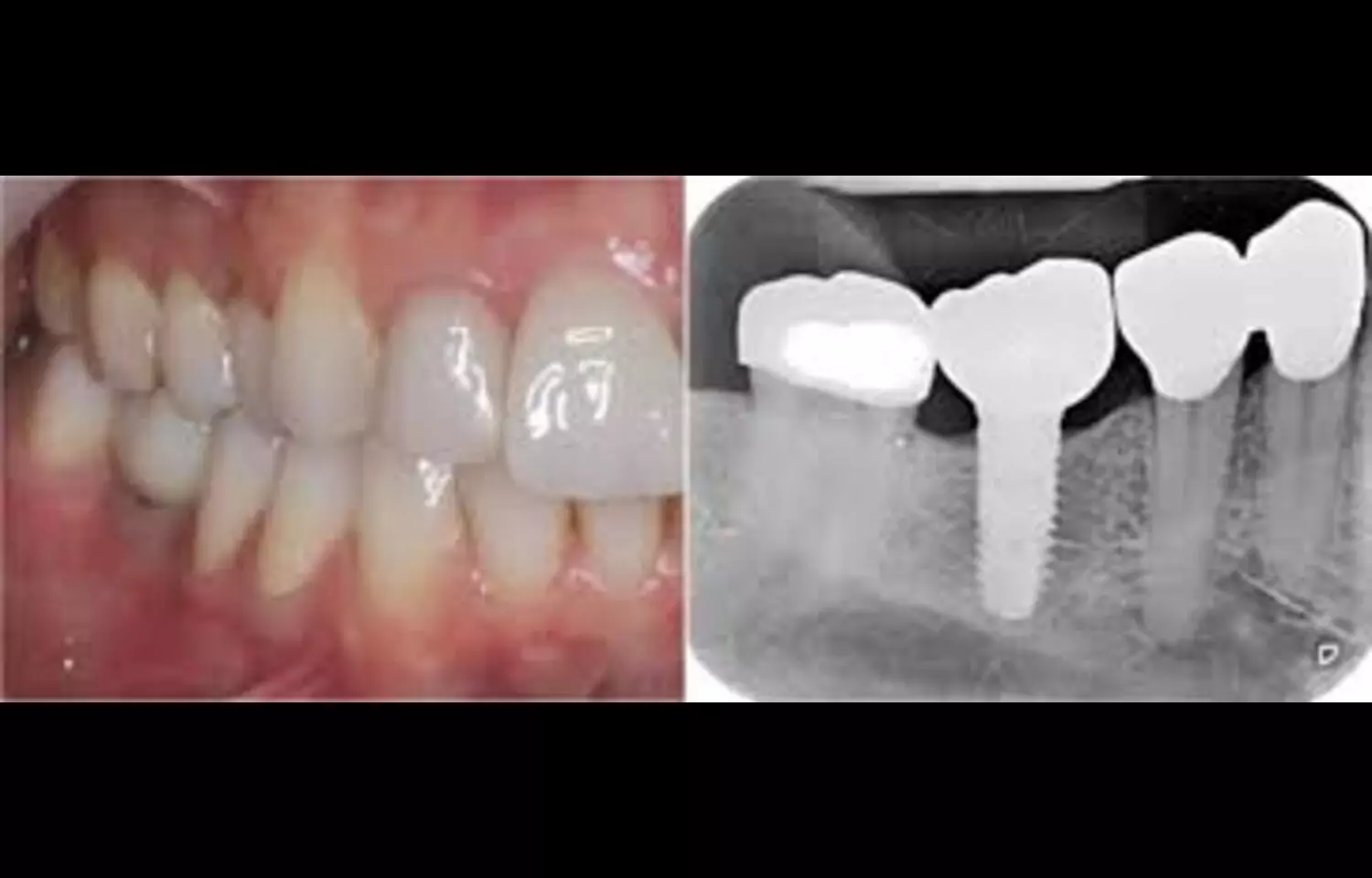 Intermediate Abutment-Healing Cap System Ensures Accurate Single Implant Scans, suggests study