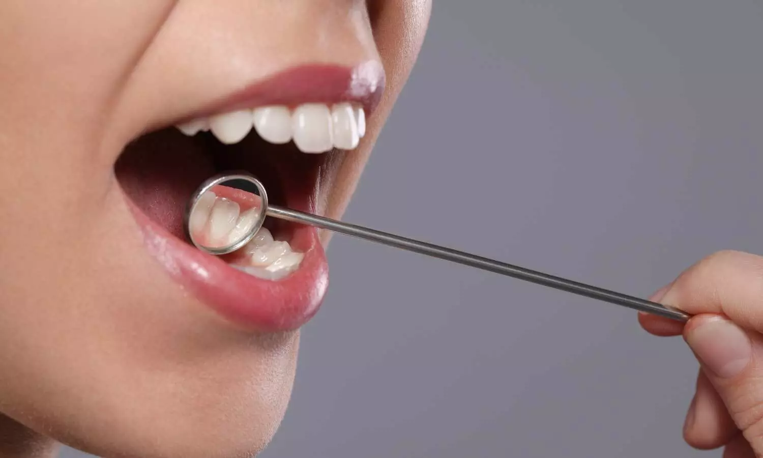 Fiber-Reinforced Restorations Improve Fracture Resistance in Endodontically Treated Teeth: Study
