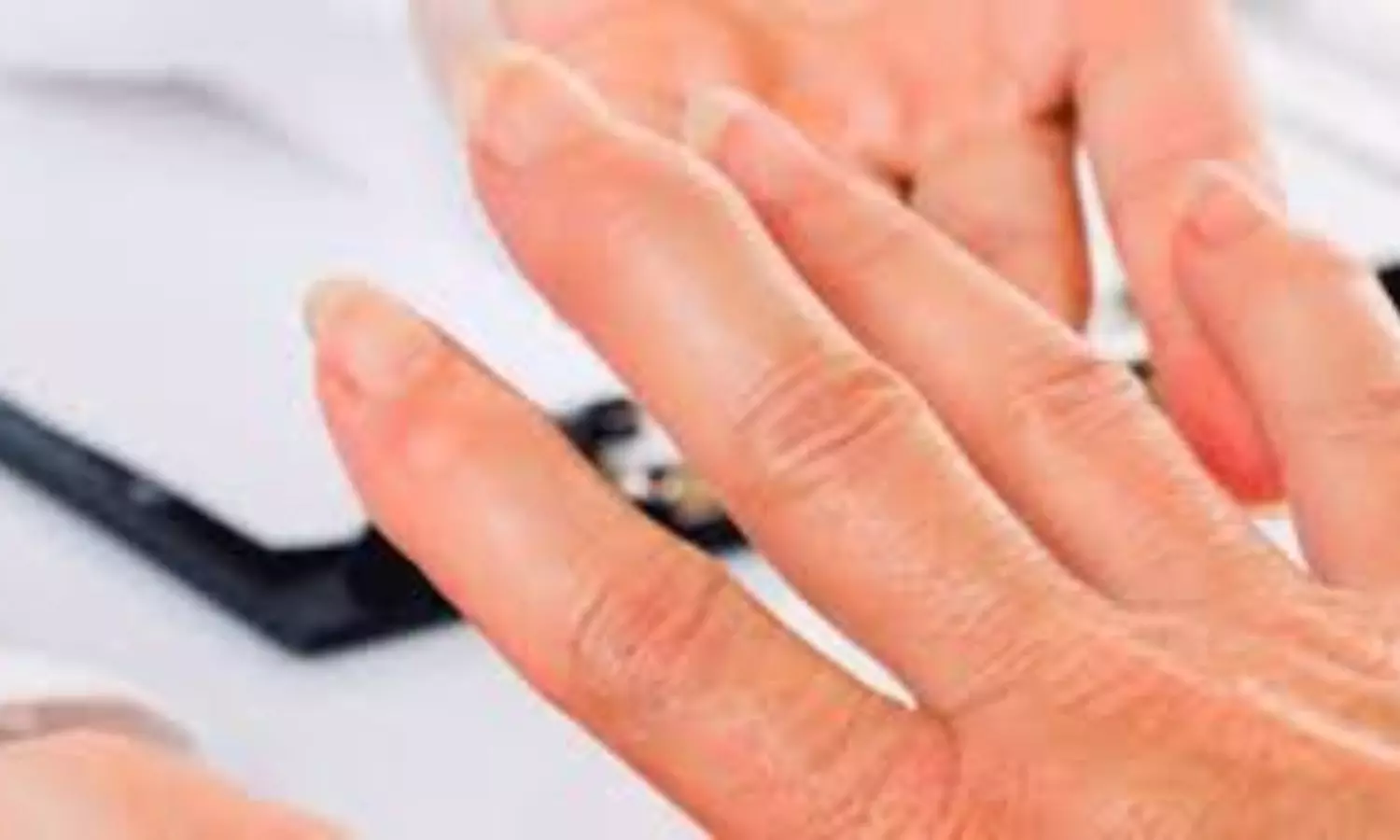 Add on clofutriben May Reduce Long-Term Corticosteroid Toxicity among polymyalgia rheumatica patients: Study