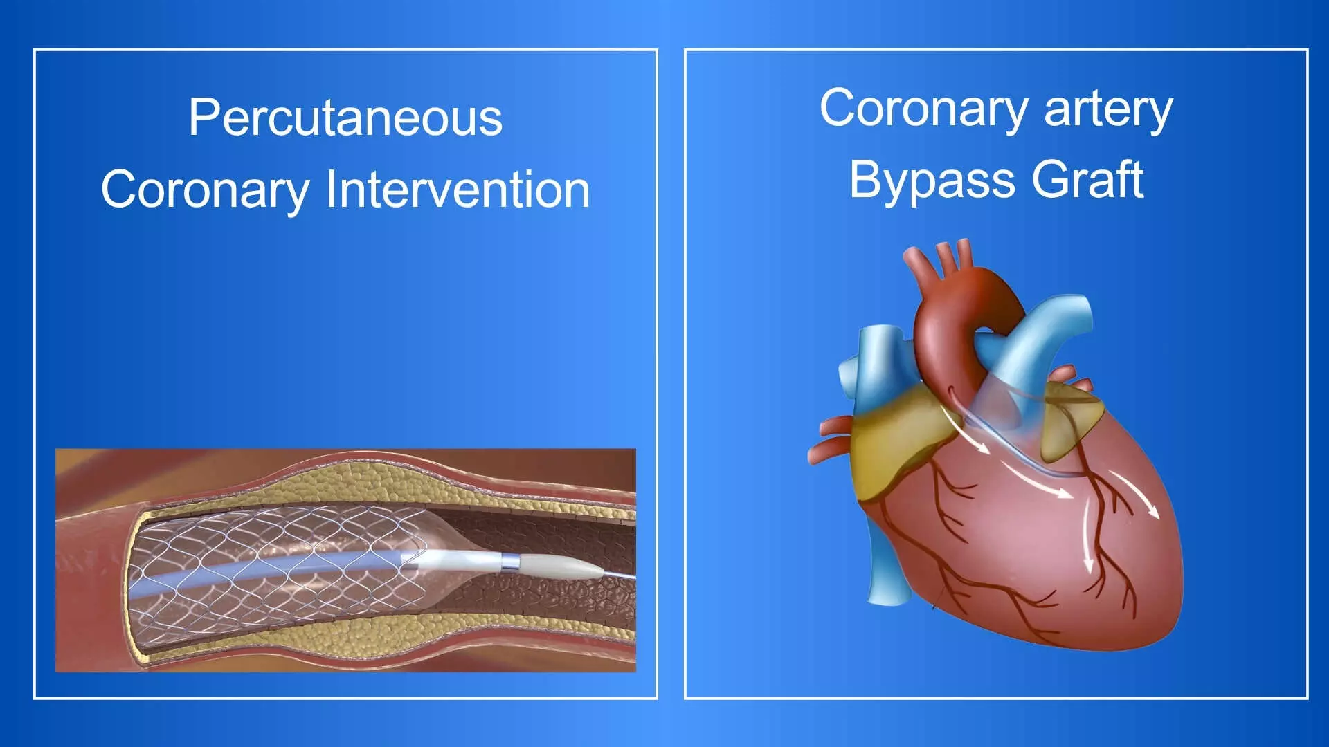 Decade-Long Study of PCI and CABG in Left Main Coronary Artery Disease Shows Comparable All-Cause mortality in NOBLE Trial: TCT 2025