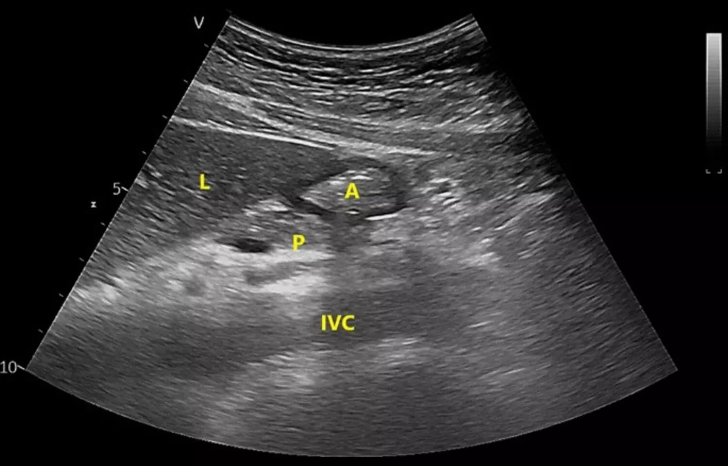 Preoperative Carbohydrate Loading Benefits in Liver Resection: Study