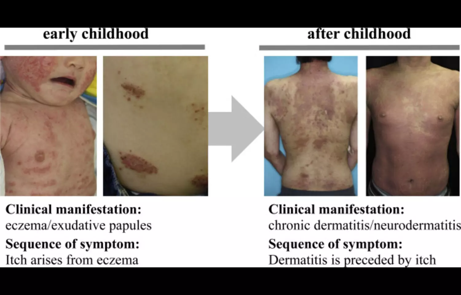 Biologic Therapy may Lower Malignancy Risk in Psoriasis,suggests study