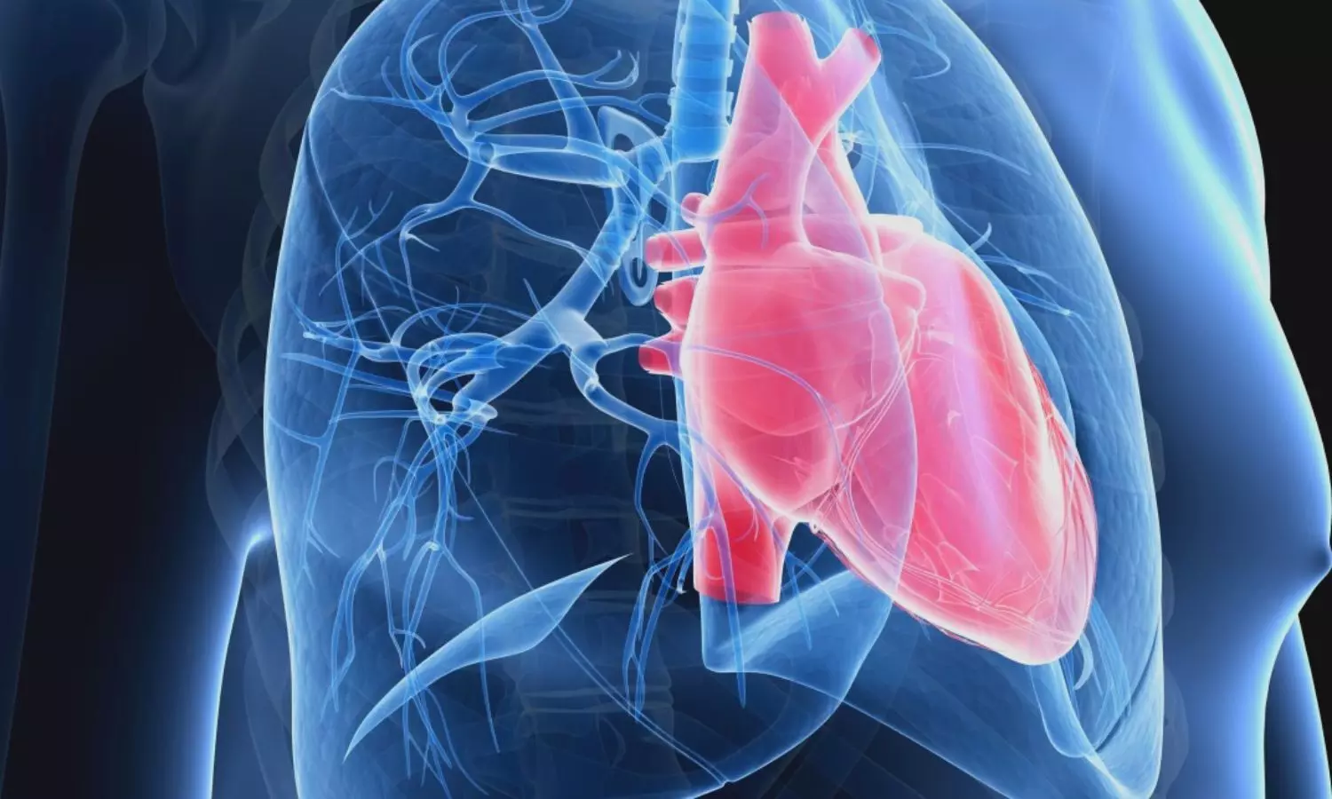 FDA Expands Indication for Sotatercept-csrk in Pulmonary Arterial Hypertension
