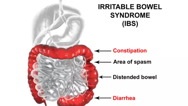IBS Patients Face Higher Risk of Developing IBD, suggests study