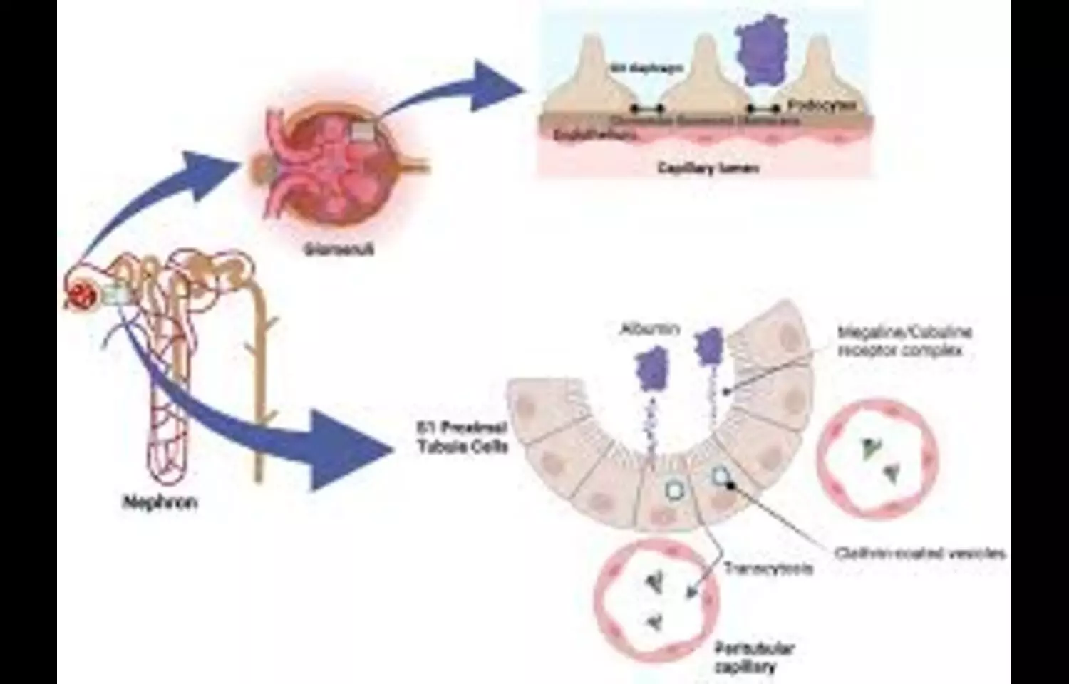 Lowering Albuminuria Improves Survival and Kidney Outcomes in Diabetes-Related CKD: Study