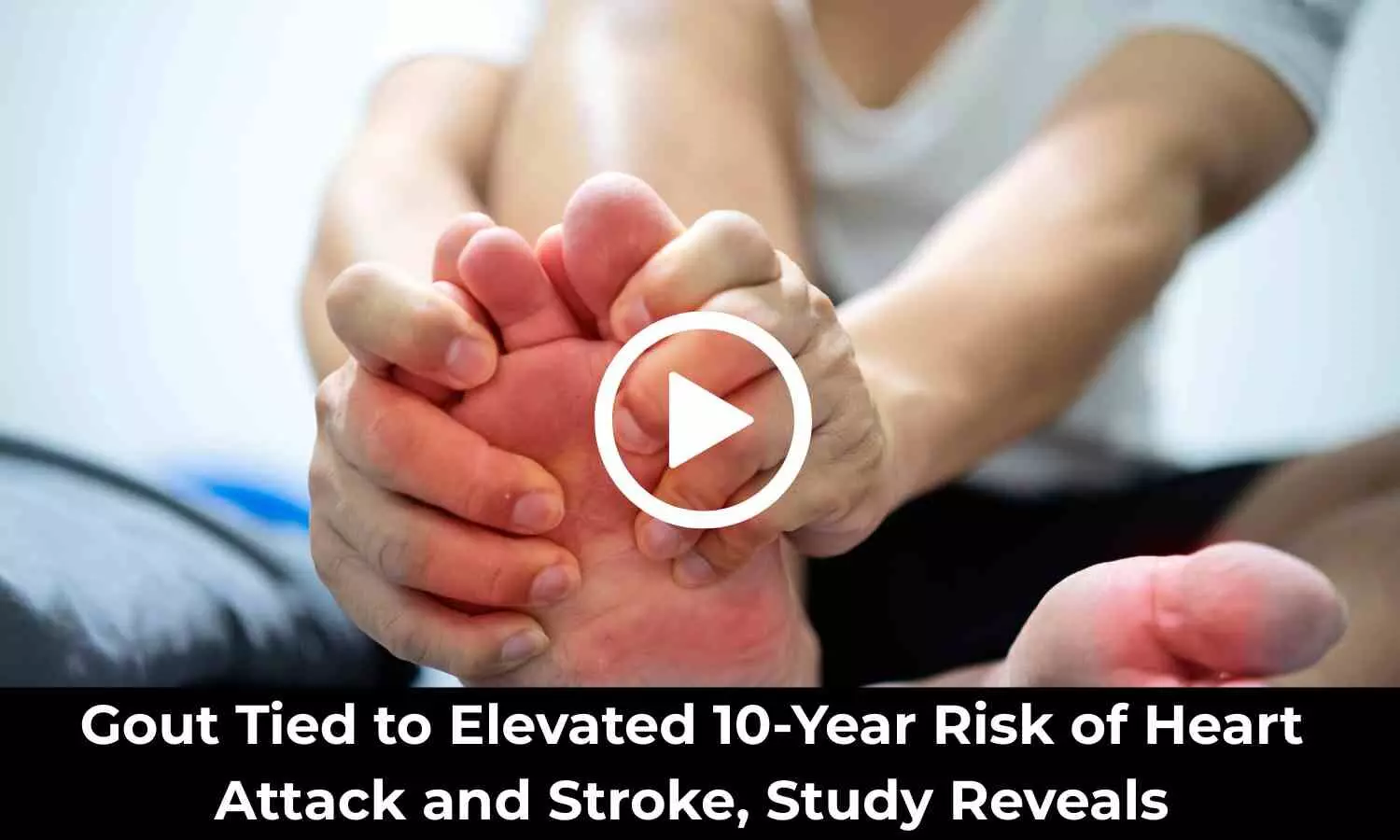 Gout Tied to Elevated 10-Year Risk of Heart Attack and Stroke, Study Reveals