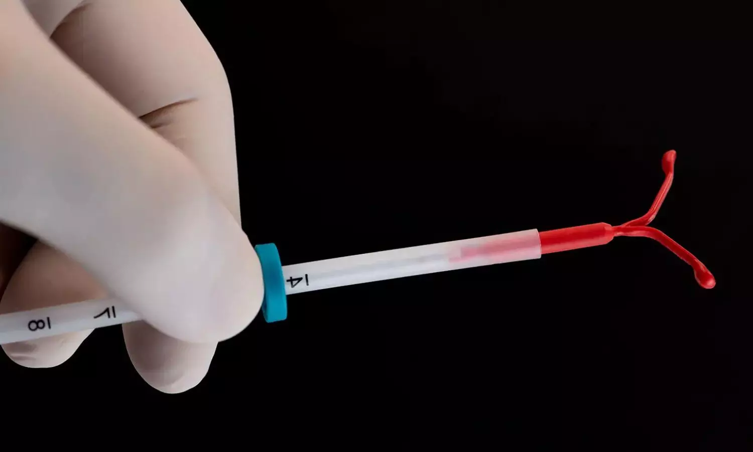 Previous use of LNG-IUS associated with decreased endometrial growth in women undergoing IVF/ICSI: Study