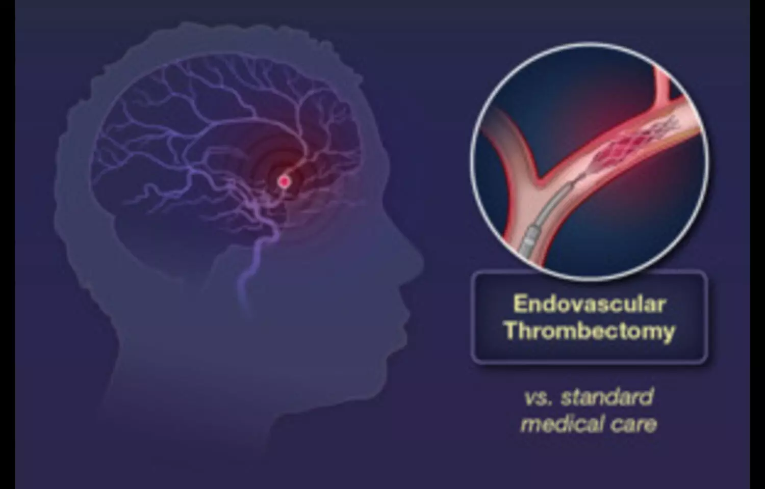 Patients undergoing endovascular Thrombectomy for Large Vessel Occlusion Stroke under GA had improved outcomes: JAMA