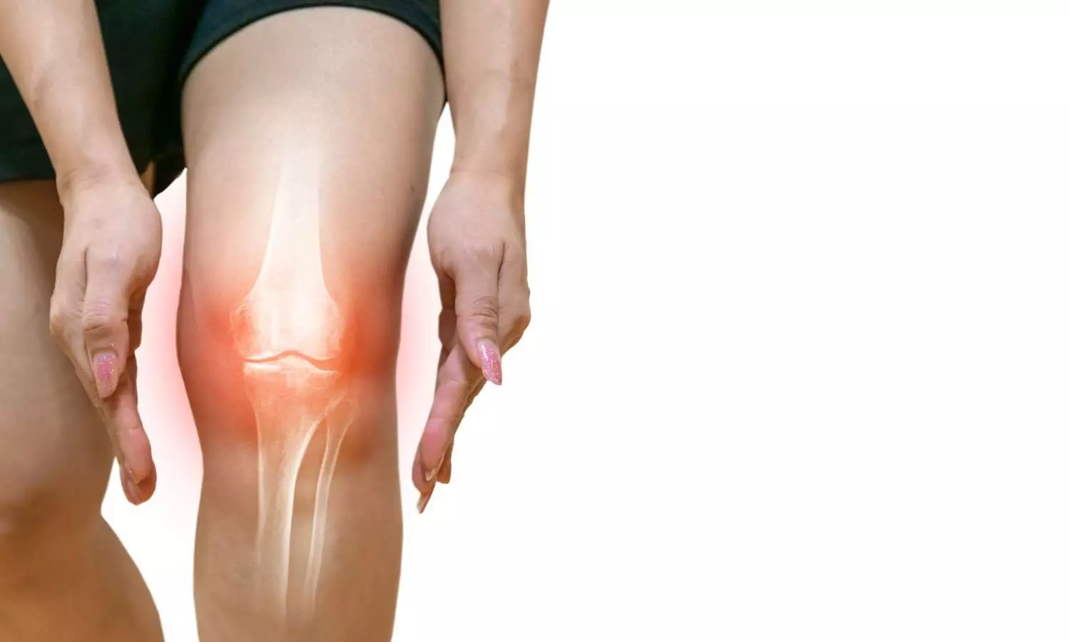 Calcium Crystal Deposits Linked to Higher Risk of Knee Osteoarthritis, 20-Year Study Finds