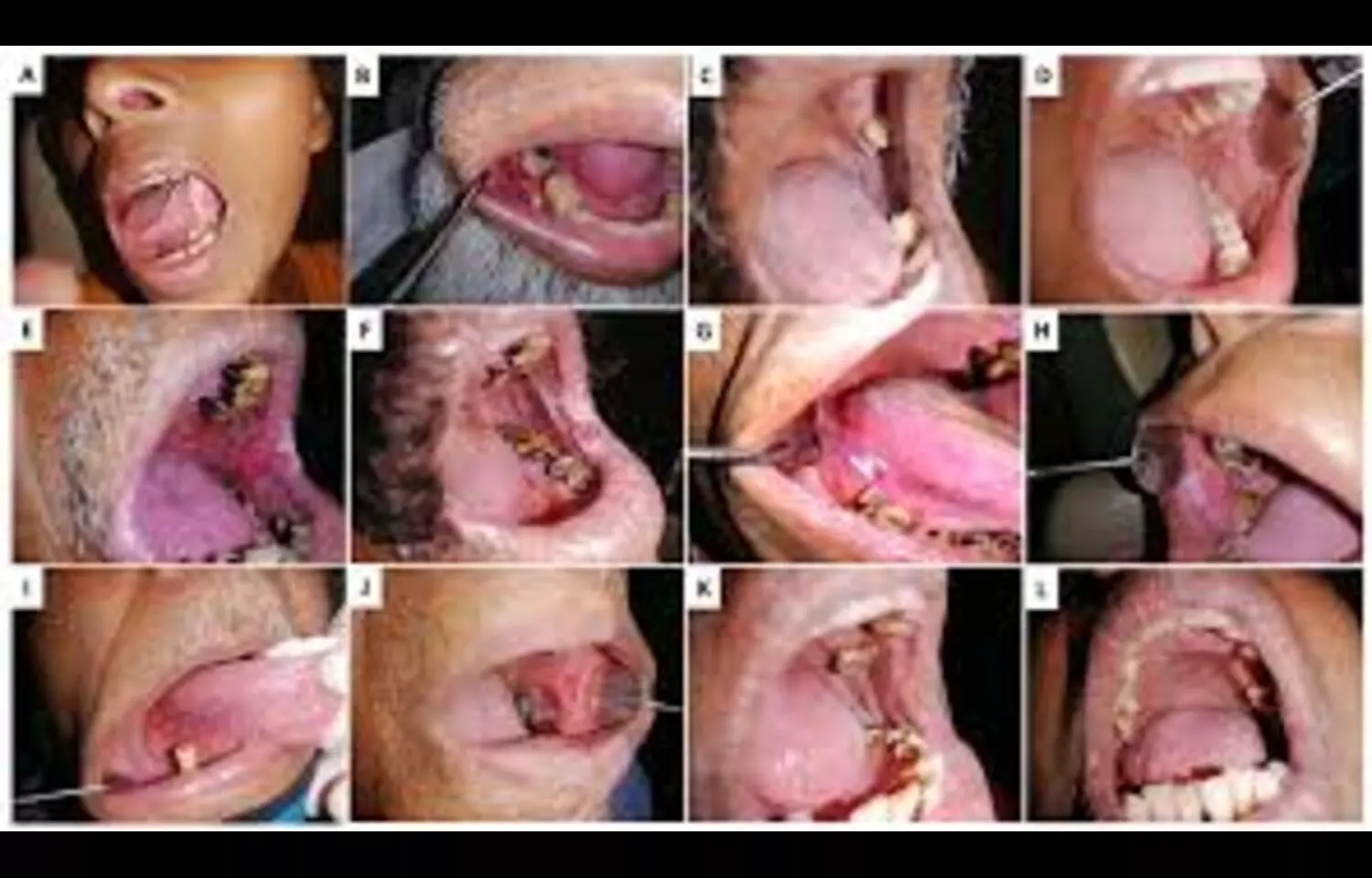 High Prevalence of Oral Potentially Malignant Disorders in Central India attributed to tobacco and areca nut use: Study