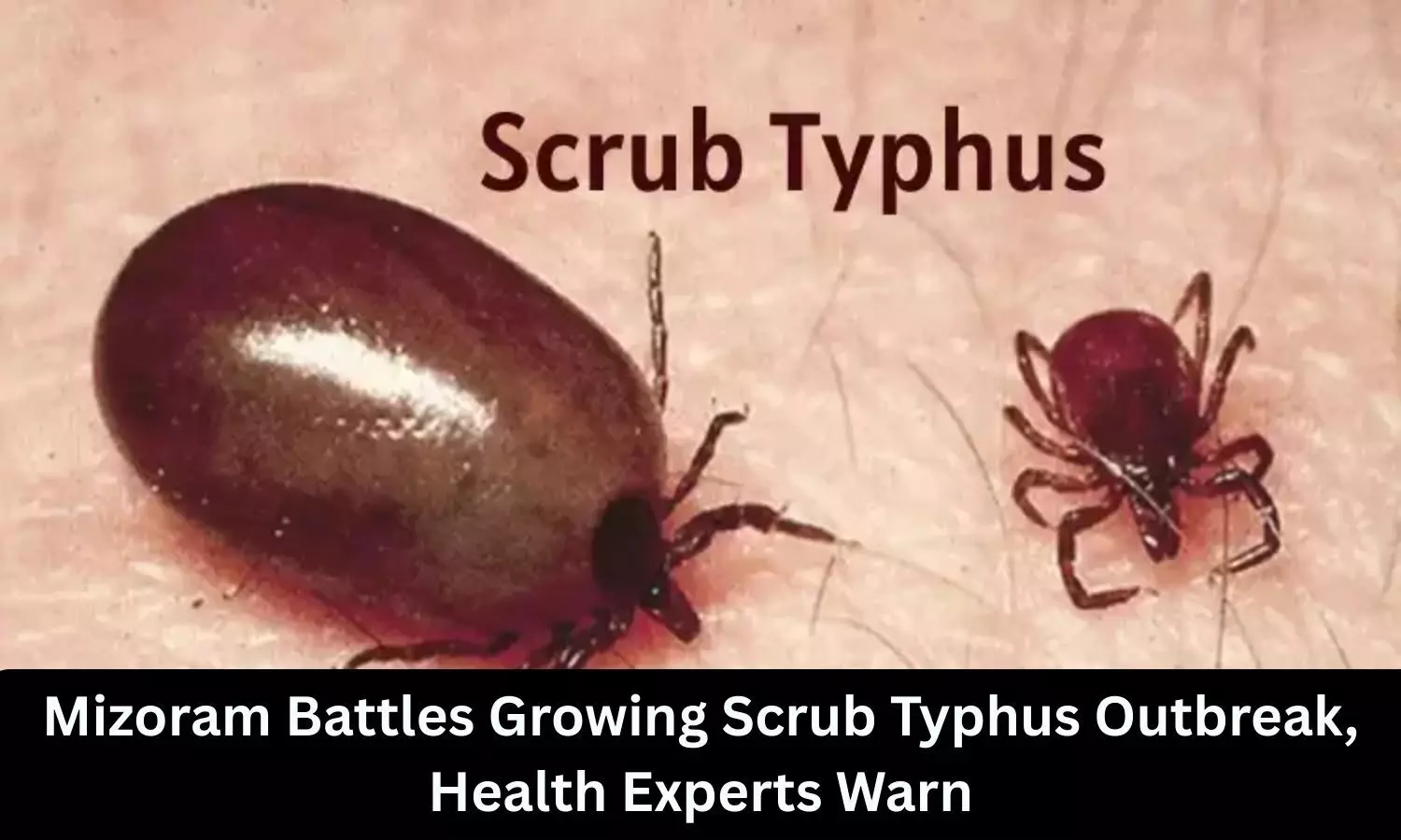 Mizoram battles Scrub Typhus outbreak, health experts warn