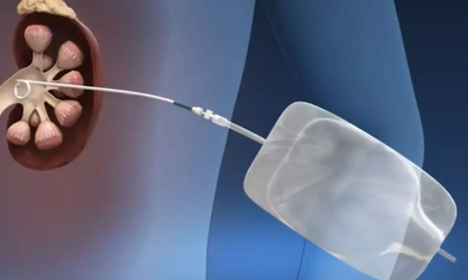 Percutaneous Nephrolithotomy Preserves Kidney Function in Patients with Severe CKD: Study