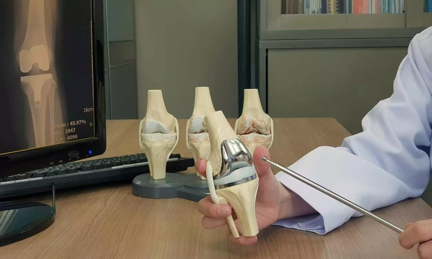NPPA Extends Price Cap on Knee Implants Until November 15, 2025
